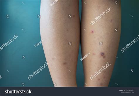 Wound Dermatitis Dark Spots On Skin Stock Photo 1017808495 | Shutterstock