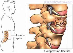 Vertebral Compression Fracture Definition, Causes, Symptoms ...