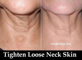 Tighten Loose Neck Skin ~ MediMiss | Loose neck skin, Skin, Homemade ...