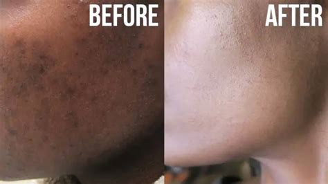 Face Pigmentation Treatment At Home - Doctor Heck