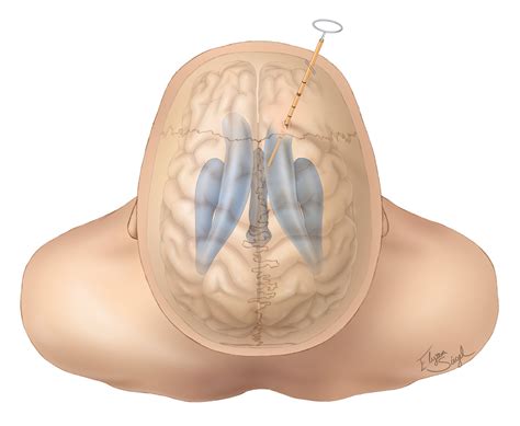 External Ventricular Drain | The Neurosurgical Atlas