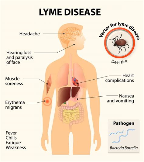 Treatment for Lyme Disease - Philadelphia Holistic Clinic - Dr. Victor Tsan