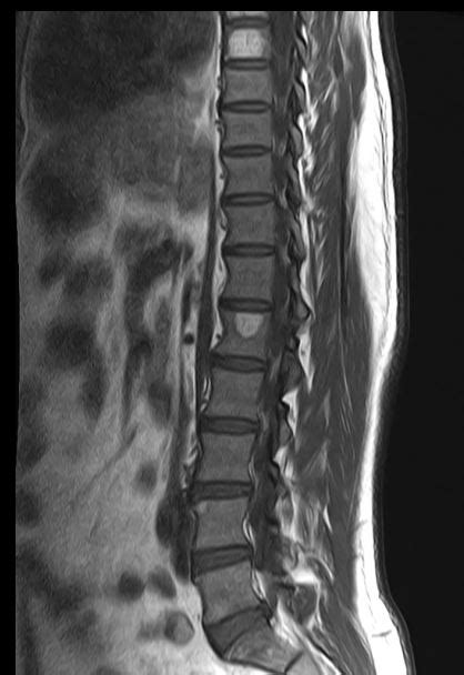 Ultimate Radiology : Vertebral Hemangiomas