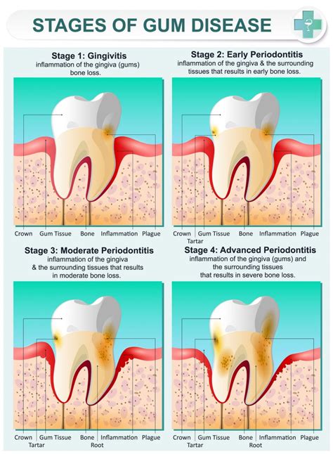 Infographic, Stages of gum Disease - Welcome to Dr. Arman Torbati's Dental Blog - Los Angeles ...