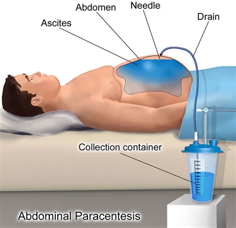 Paracentesis Procedure - Abdominal Paracentesis Position, Complications