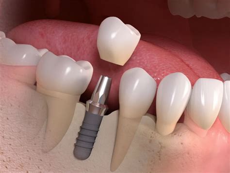 Implant Crown - Replace Single Missing Tooth Permanently