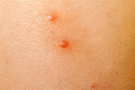 Molluscum Contagiosum | Wisconsin Department of Health Services