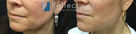 Voluma Filler for Jawline, Chin, Marionette Indentation Before & After ...