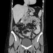 Diffuse peritoneal leiomyomatosis | Radiology Reference Article ...