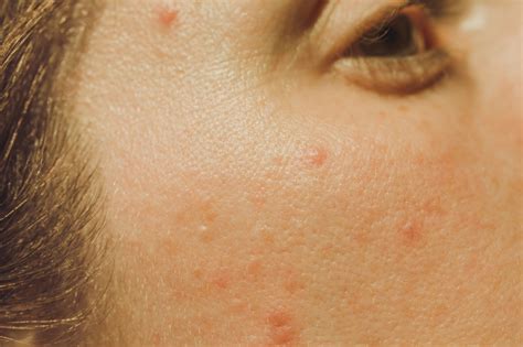 Your Guide to Every Single Type of Acne in 2021 | Types of acne, Dermatologist acne, Nodule acne