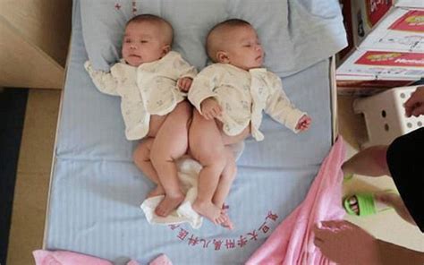 Chinese conjoined twins will be separated using 3D printing | Daily Mail Online