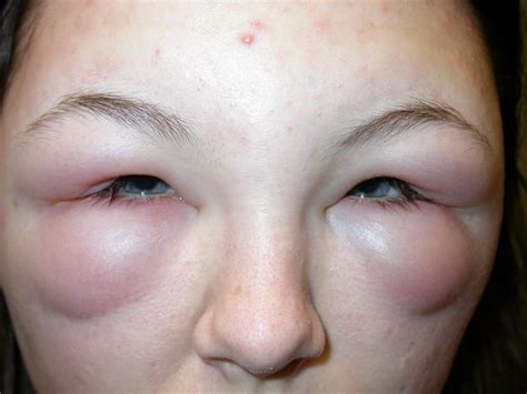 Conjunctivitis (Allergic, Infective) - Eye Surgery LTD