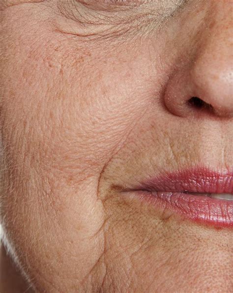 Aging Skin Tucson | Wrinkle Smoothing Catalina Foothills