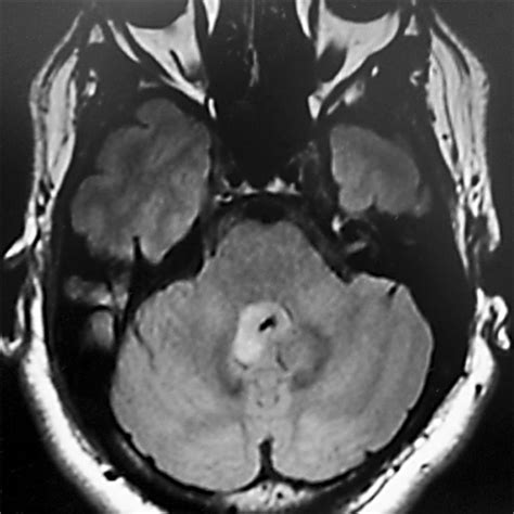 Floor Of 4th Ventricle Mri | Viewfloor.co