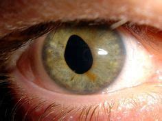 A condition characterized by unequal pupil size is - latindop