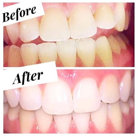 Pin on amazing whitening toothpaste