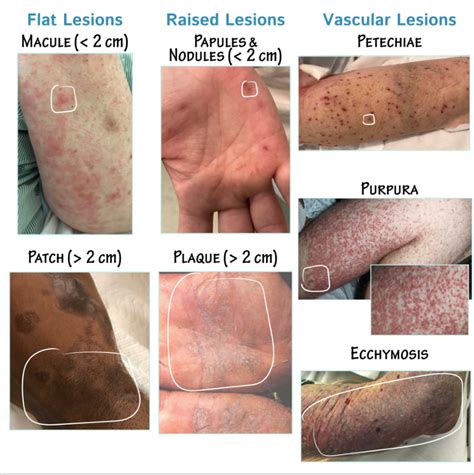 Purpura Vs Petechiae