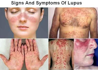 Lupus Disease Signs And Symptoms, Diagnosis And Treatment | Health And Beauty