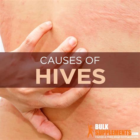 Hives: Symptoms, Causes & Treatment by James Denlinger