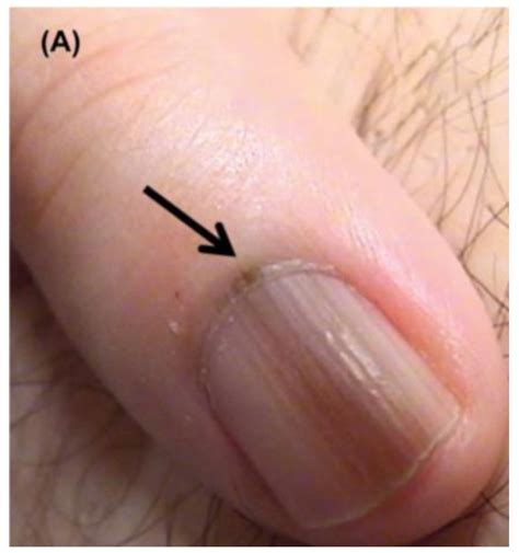 Cells | Free Full-Text | Adult and Pediatric Nail Unit Melanoma: Epidemiology, Diagnosis, and ...