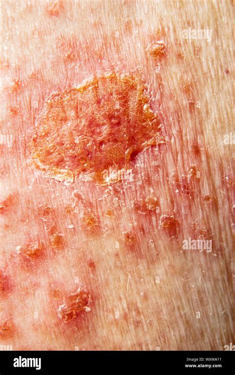 Skin Cancer Basal Cell Carcinoma Stock Image M1310746 - vrogue.co