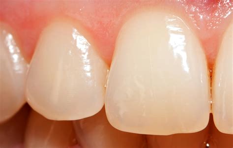 Effect of Enamel & Tooth Surface Wear on Patients’ Quality of Life ...