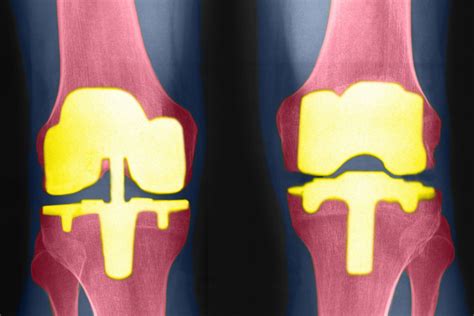 Types of Bilateral Knee Replacement