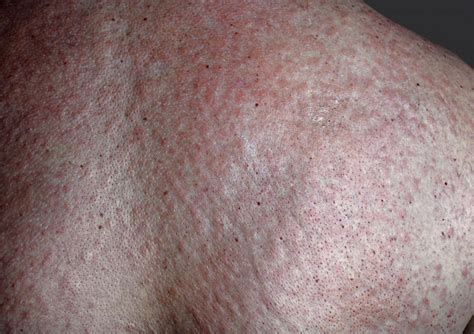 Pustular psoriasis: Causes, risk factors, symptoms. and types