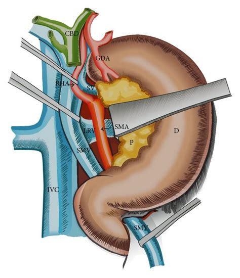 Hind right approach PD: after extended Kocher maneuver the... | Download Scientific Diagram