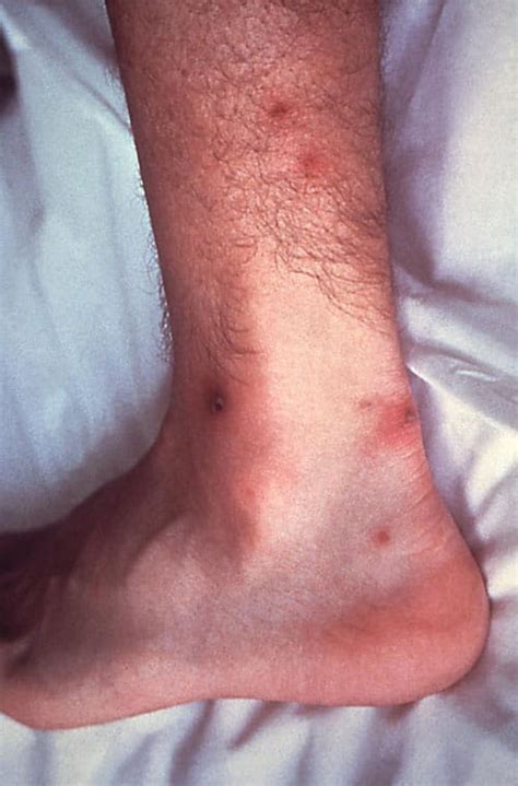 Image: Disseminated Gonococcal Infection (Skin Lesions) - MSD Manual ...