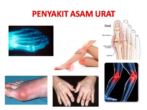 Lintas Blog: Obat Asam Urat Tradisional dari Tumbuhan