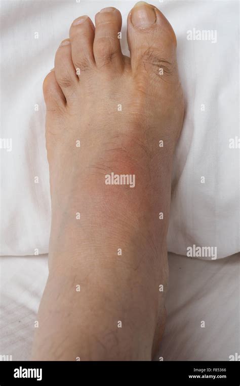 A swollen left foot with gout Stock Photo, Royalty Free Image: 91081374 ...