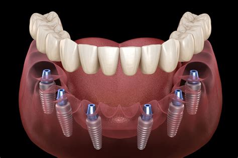 What to Expect When You Have Full Arch Dental Implants | Durham Dental Solutions