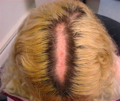 VIRTUAL GRAND ROUNDS IN DERMATOLOGY 2.0: Scalp Burn Post-Beauty Parlor Visit