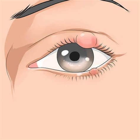 Chalazion Treatment | Chalazion Surgery | Chalazion Eye Treatment