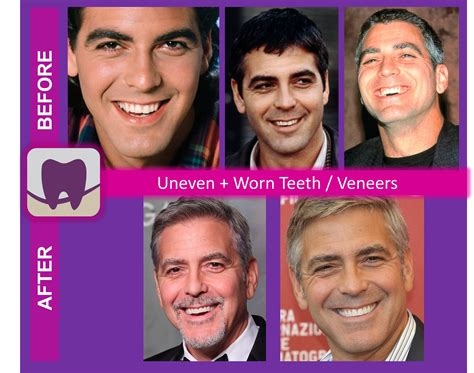 Celebrity Smiles Revealed: George Clooney • Stouffville SMILES ...