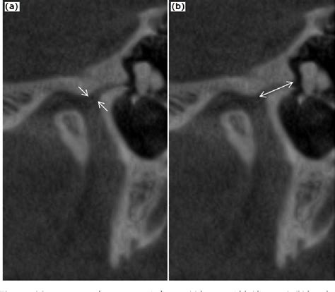 Figure 2 from Petrotympanic Fissure Architecture and Malleus Location in Temporomandibular Joint ...