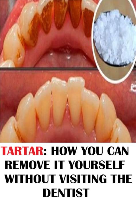 Tartar: How you can Remove it Yourself Without Visiting the Dentist ...