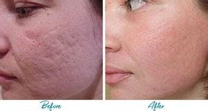 Acne Scar Removal NYC | Laser Acne Scar Treatment Clinic