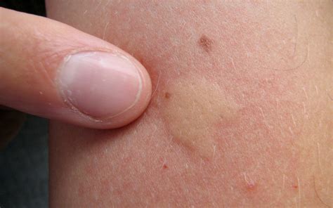 Itchy Red Bumps On Skin Like Mosquito Bites | Better Health Channel