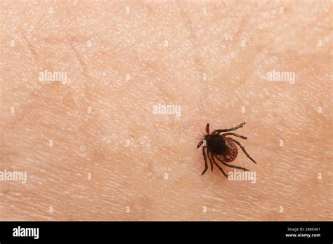 Tick bite hi-res stock photography and images - Alamy