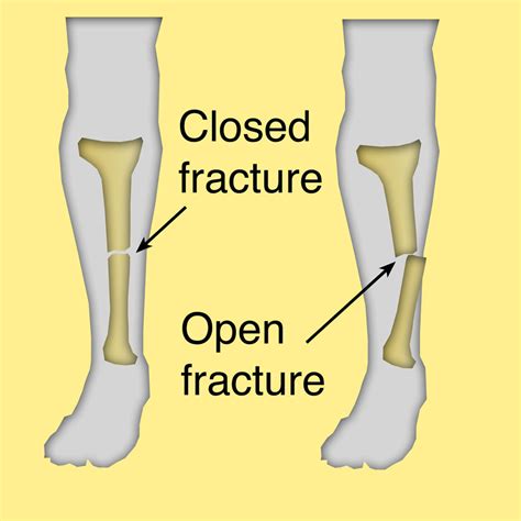 Fractures in Children | Outstanding Care | Orthopedic Surgeon in Kenya