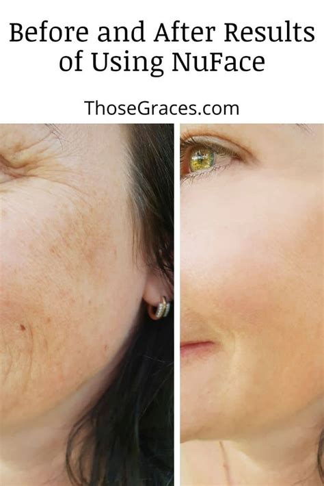 Nuface Toning Device: Before & After Results of Using - ThoseGraces.com