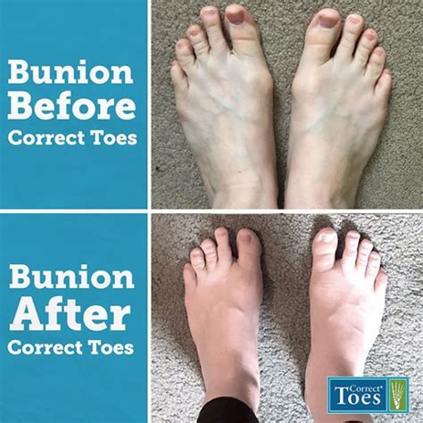 Correct Toes® Australia | The World's Best Toe Spacer - Natural Foot Health