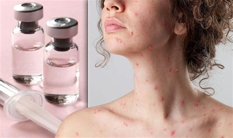 Is there a chicken pox vaccine? - Sound Health and Lasting Wealth