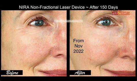 Unlocking the Secret to Youthful Skin: Nira Skincare Laser Reviews - Miradore MDM Software ...