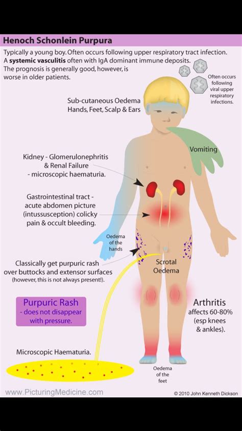 Henoch Schonlein Purpura. A classic pattern of disease as shown in the diagram below. This is ...