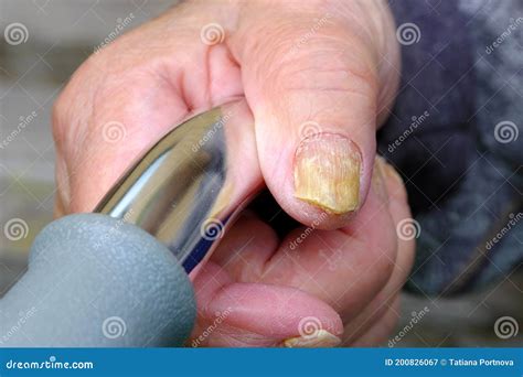 Fungal Nail Infection. Onychomycosis, Also Called Tinea Unguium Royalty-Free Stock Image ...