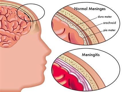 Meningitis: Symptoms, Diagnosis, Cures and More! | MD-Health.com