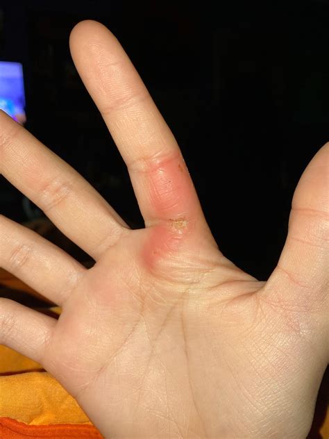 progress of my second degree burn blisters. : r/MedicalGore